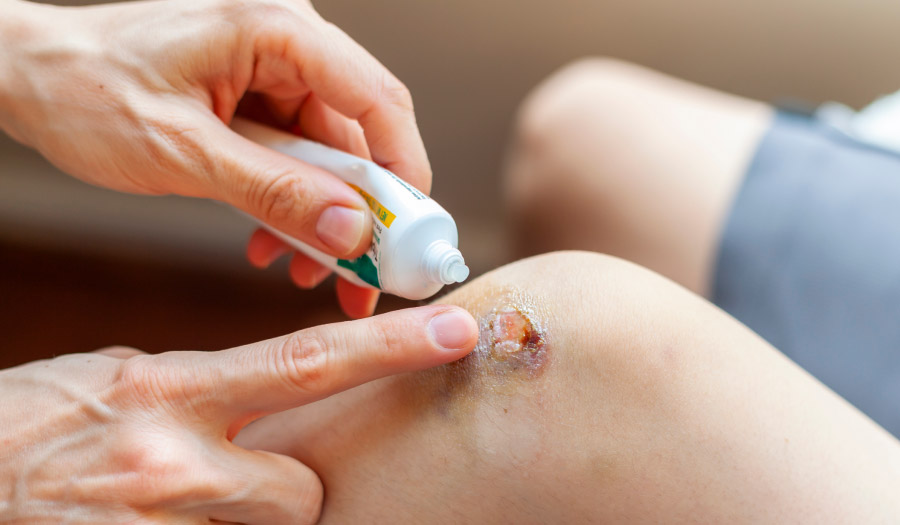 Polysporin or Neosporin